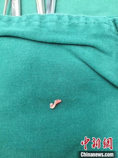 男童呛入鱼骨呼吸衰竭多学科医生协作开胸取出