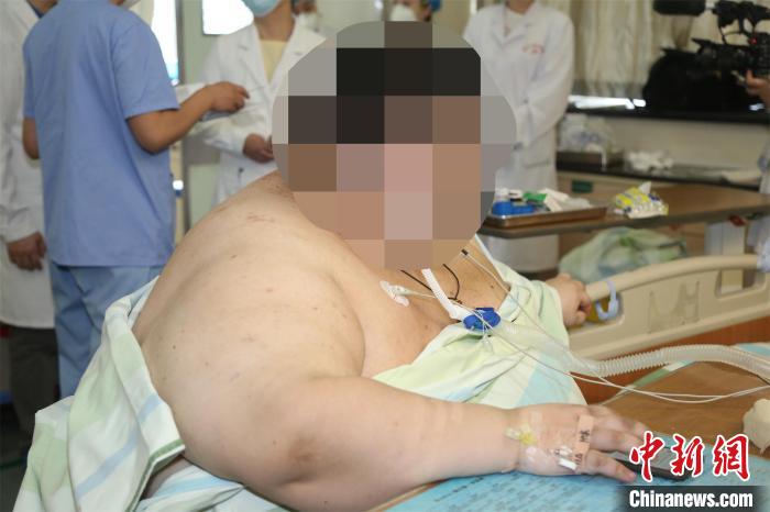 男子体重达556斤出现心衰入院治疗转危为安