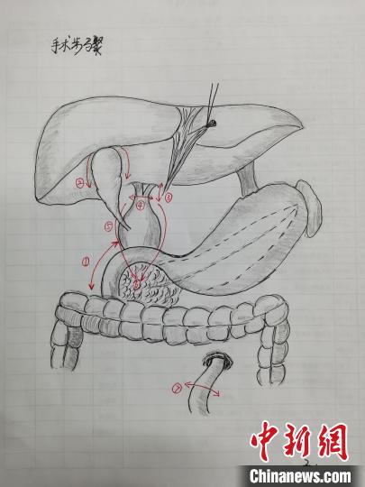 西安护士变身“灵魂画手”手绘上百张手术图为患儿家属解忧